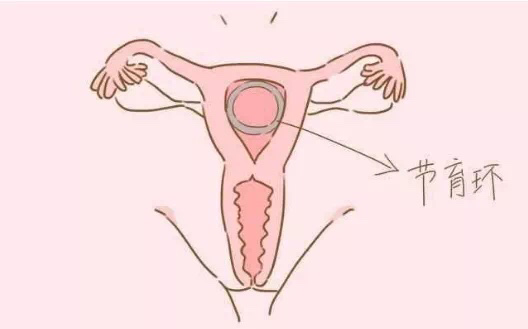 kaiyun体育登录网页入口 【科普】女性上环的（利弊）好处和坏处，上环，取环你必须了解的那些事儿