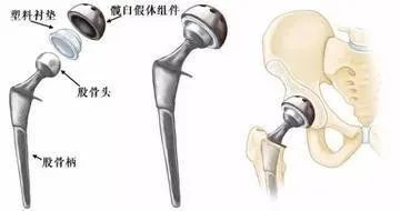 髋关节训练椅_髋关节训练椅说明书_髋关节坐姿