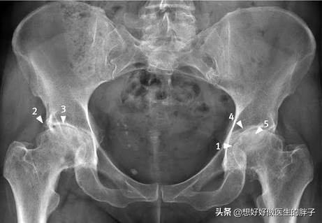开yun体育官网入口登录体育 髋关节疼痛很常见，令很多人苦恼，这些康复锻炼方法您可以尝试下