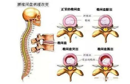 腰椎稳定性训练_博恩斯摇摆椅_髋关节训练椅