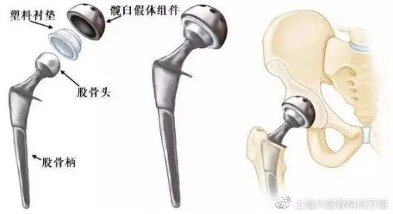 髋关节训练器_髋关节训练器的适应症_髋关节训练椅