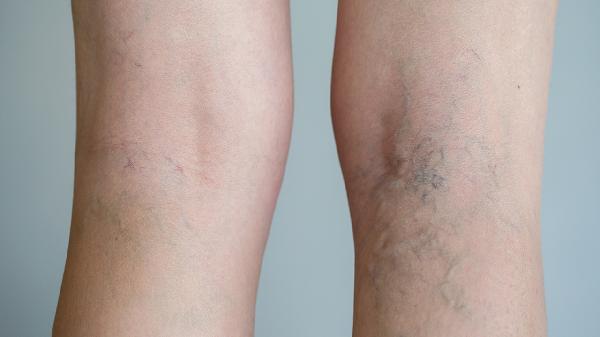 股四头肌训练椅_股四头肌肌腱损伤康复训练方法_股四头肌肌腱损伤治疗方式