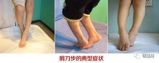 开yunapp体育官网入口下载手机版 脑瘫患儿剪刀步应该如何做康复训练